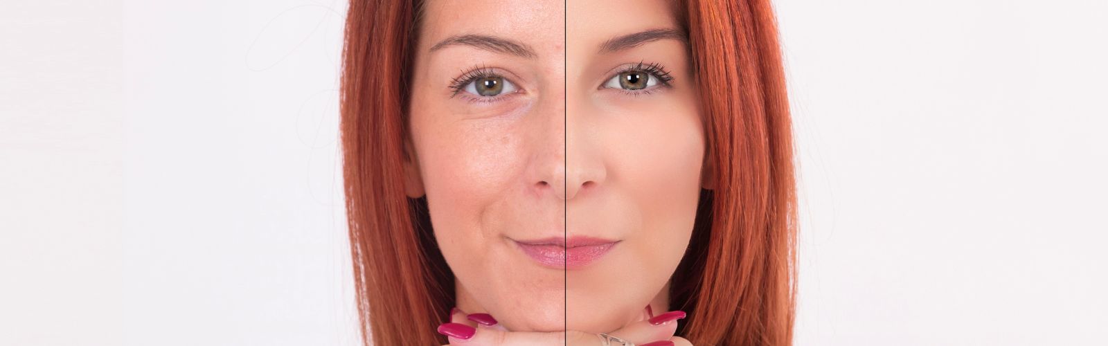 Antes e Depois do Colágeno Verisol: Resultados Comprovados